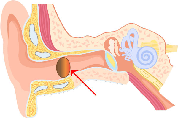 Illustration of an Ear With A Blocked Eardrum