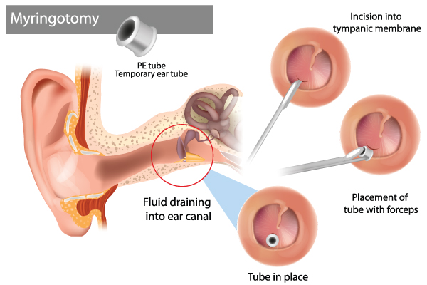 Illustration of Myringotomy Procedure With Ear Tube Placement